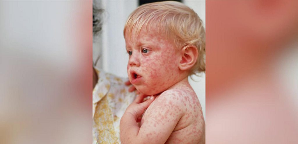 17 children die of measles