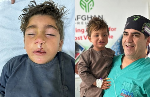 Surgeries of 106 children with cleft lip, palate conducted in Helmand 