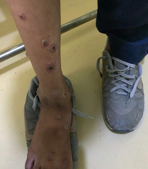 First positive case of monkeypox registered in Afghanistan 